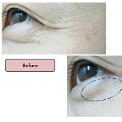 VIVACE - alegere simpla si inteligenta pentru efect anti-aging  garantat, fara durere si fata timp de recuperare