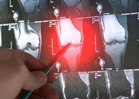 Primele semne ale cancerului osos: simptome pe care nu ar trebui să le ignori