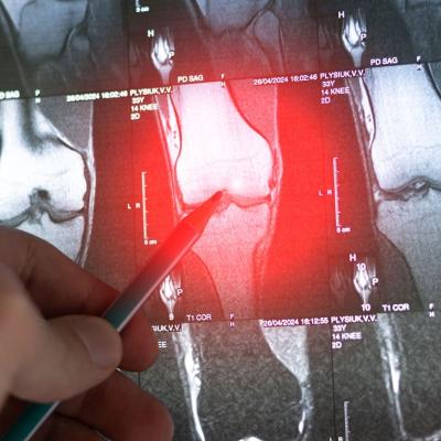 Primele semne ale cancerului osos: simptome pe care nu ar trebui să le ignori 