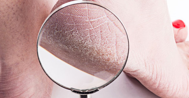 Cum scapam de CALCAIELE CRAPATE