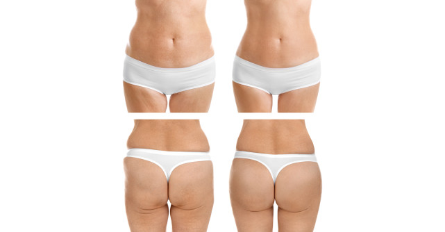 Liposuctia si lipofilling, minunea in 2 pasi facuti impreuna