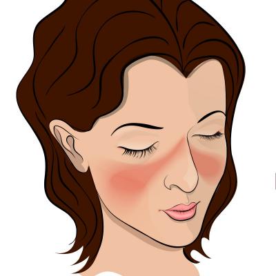 Lupus, boala autoimuna cronica ce poate afecta orice parte a corpului