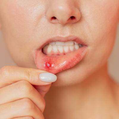 Leacuri bătrânești pentru afte - remedii naturale eficiente