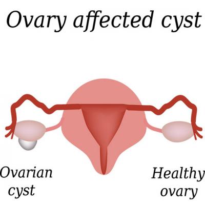 5 Tratamente naturiste pentru CHISTUL OVARIAN