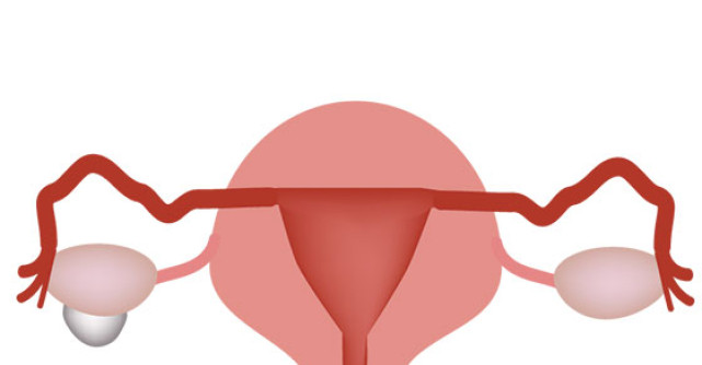 5 Tratamente naturiste pentru CHISTUL OVARIAN