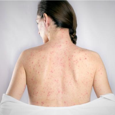 Rubeola – cine este in pericol si cum influenteaza femeile gravide: simptome, cauze si tratament