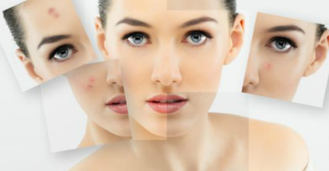 3 Pasi pentru un ten fara acnee