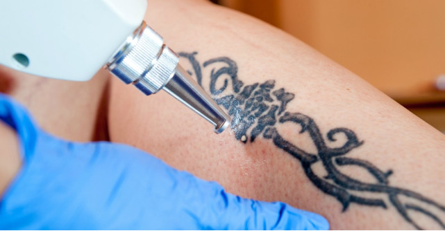 Vrei sa iti stergi tatuajul? Iata ce trebuie sa stii