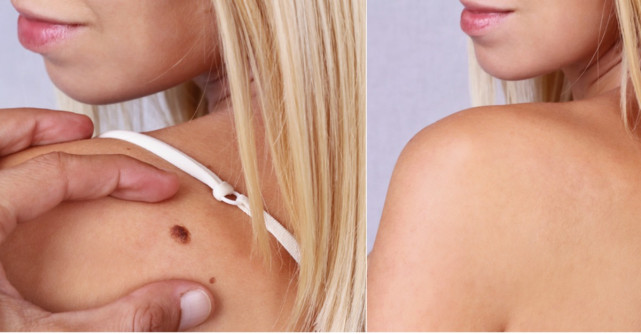 5 raspunsuri esentiale pe care e bine sa le afli inainte sa iti scoti o alunita