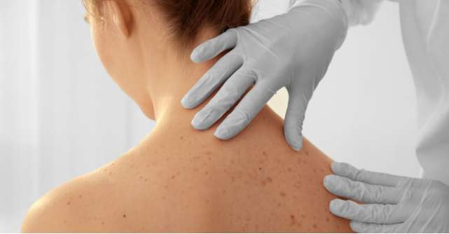 Cancerul de piele si riscurile la care te supui: simptome, cauze, diagnostic si tratament
