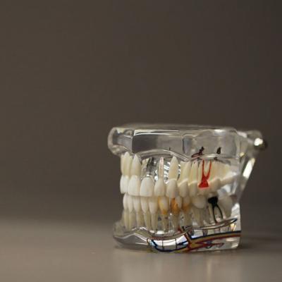 Implantul dentar: 6 semne ca ceva este in neregula!