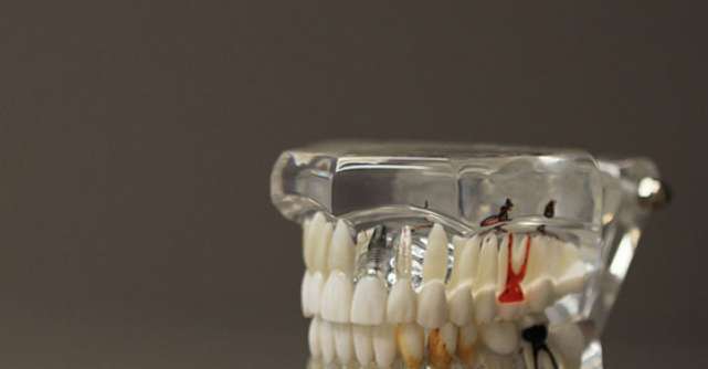 Implantul dentar: 6 semne ca ceva este in neregula!