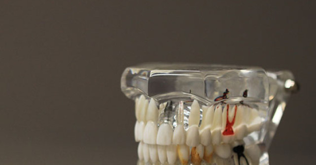 Implantul dentar: 6 semne ca ceva este in neregula!