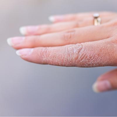 Dishidroza,un rezultat al stresului