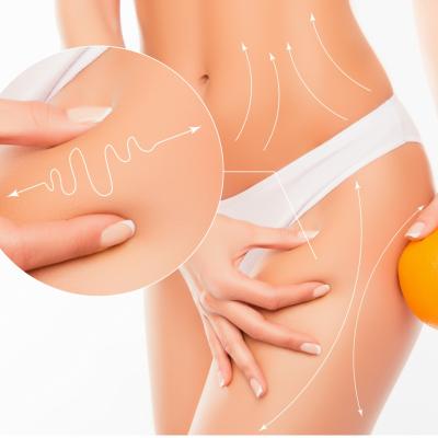 Cum să scapi de celulită: radiofrecvența, tratamentul-minune!