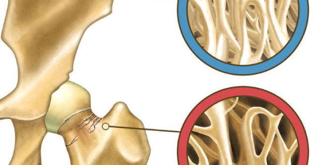 Boala care iti FURA calciul din oase