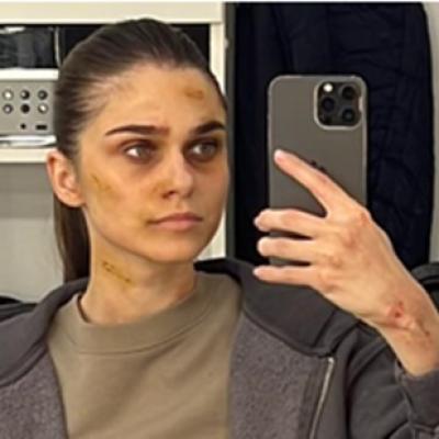 Theo Rose a suferit o intervenție la nivelul feței, după un consult medical: Nu simt nimic...