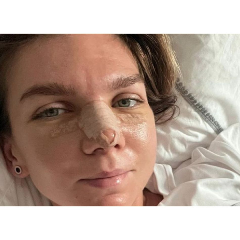 Cum arată Simona Halep, după intervenția suferită la nivelul nasului? Sportiva și-a dat bandajul jos și s-a pozat așa!