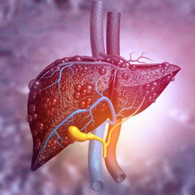 Tot ce trebuie sa stii despre ficatul gras: cauze, simptome si tratament