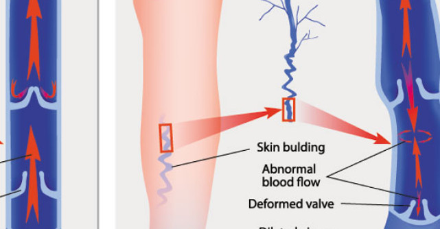 Berea scade riscul de tromboza venoasa