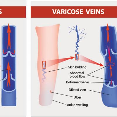 Berea scade riscul de tromboza venoasa