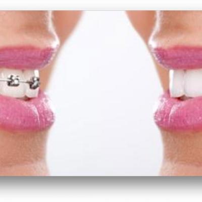 Ce trebuie sa stim inainte de montarea aparatului dentar