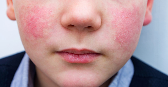 Top 4 lucruri pe care trebuie să le știi despre boala obrajilor pălmuiți