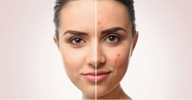 3 proceduri dermatocosmetice recomandate in aceasta toamna pentru o piele radianta