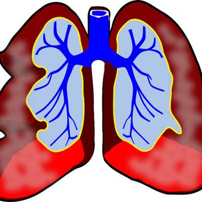 BPOC (bronhopneumopatie obstructiva cronica) 