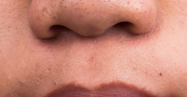 Pas cu pas: Cum sa scapi de PUNCTE NEGRE si pori dilatati