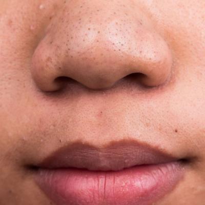 Pas cu pas: Cum sa scapi de PUNCTE NEGRE si pori dilatati