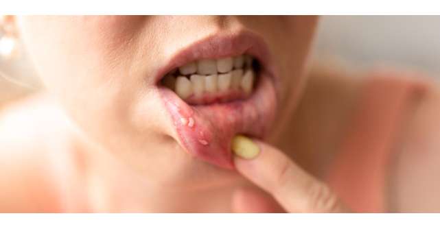 Ce sunt aftele bucale și cum îți afectează starea de sănătate