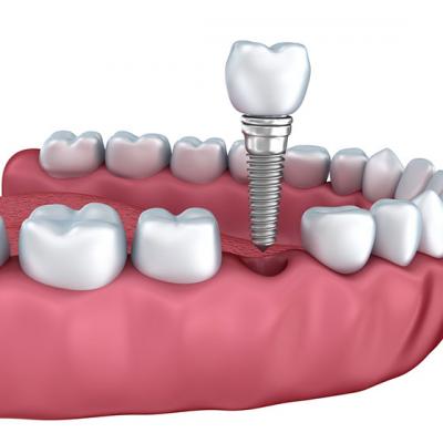 De ce este implantul dentar o solutie mai buna decat puntea dentara?