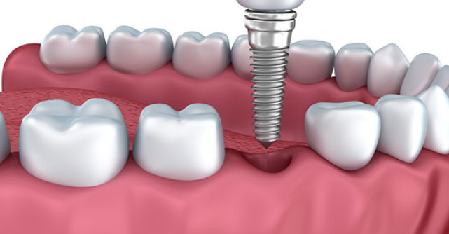 De ce este implantul dentar o solutie mai buna decat puntea dentara?