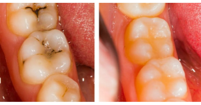 Trateaza cariile dentare cu UN SINGUR ingredient chiar la tine acasa