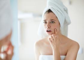 De ce nu e bine să storci coșurile? 9 motive pe care ar trebui să le știi