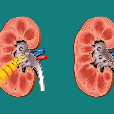 Tratament modern pentru pietrele la rinichi: Litotriția extracorporeală cu unde de șoc ESWL