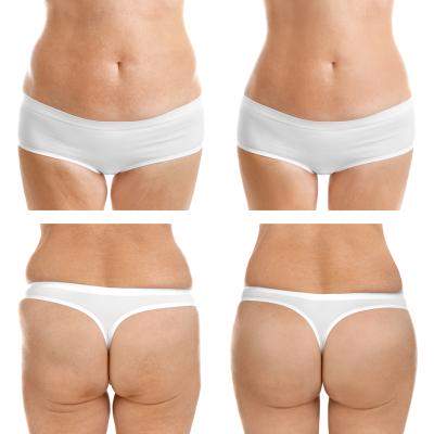 Liposuctia si lipofilling, minunea in 2 pasi facuti impreuna