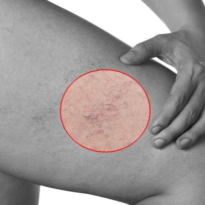 Tromboflebita: ce este si care sunt cauzele aparitiei acestei afectiuni