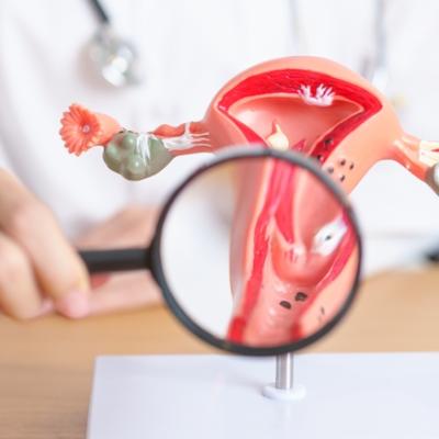 Cum se diagnostichează endometrioza: 7 investigații și teste recomandate 