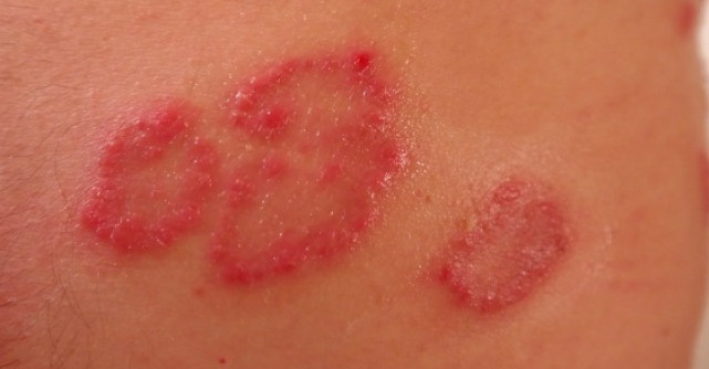 Pitiriazis versicolor apare frecvent pe piept si spate