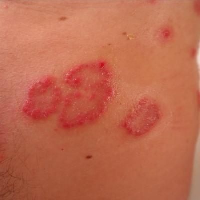 Pitiriazis versicolor apare frecvent pe piept si spate