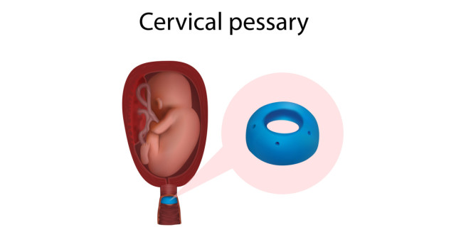 Ce este un pesar, ce trebuie să știe femeia însărcinată și cum ajută în incontinența de col sau 