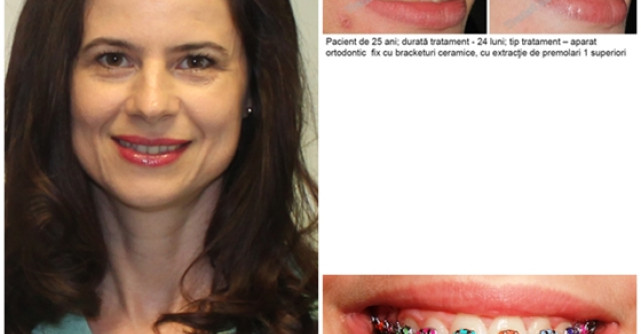 6 mituri despre aparatele dentare