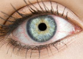 Hemoragia subconjunctivala sau ochii rosii