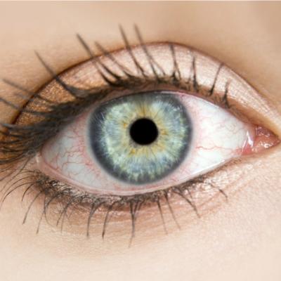Hemoragia subconjunctivala sau ochii rosii