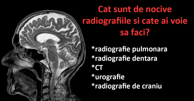 Cat sunt de nocive radiografiile si cate ai voie sa faci?