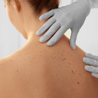 Cancerul de piele si riscurile la care te supui: simptome, cauze, diagnostic si tratament
