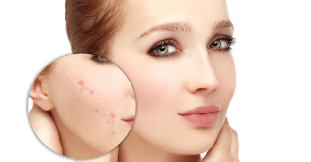 Cuperoza - sau ce se intampla de fapt cu tenul tau