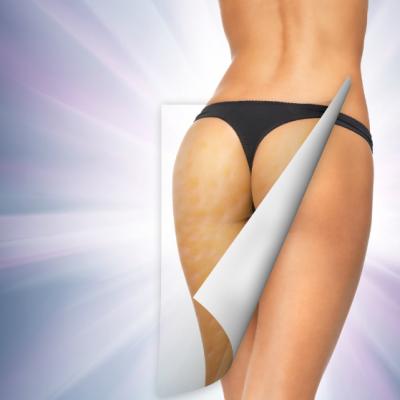 10 metode eficiente pentru a scapa de celulita definitiv